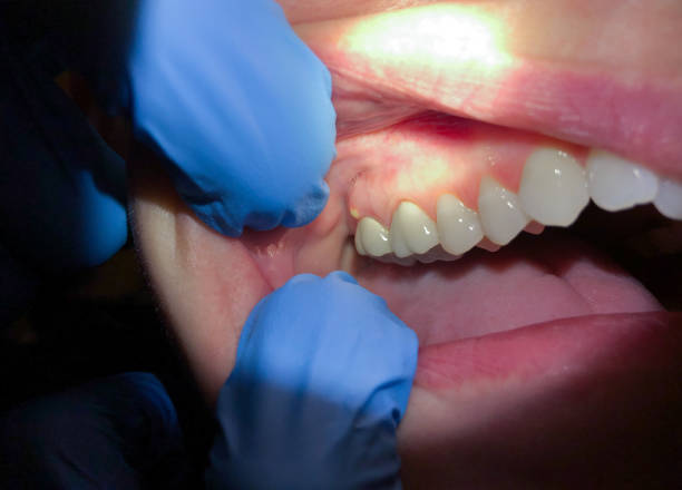 Best Emergency Dentist for Knocked-Out Tooth in Pleasureville, KY